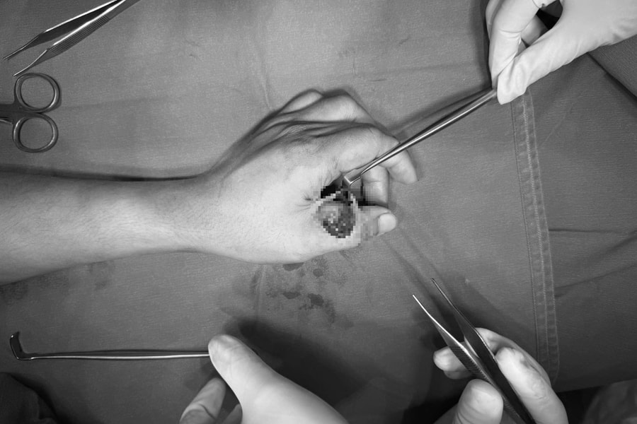 Khối u bất thường ở ngón cái tồn tại suốt 17 năm, ăn mòn xương ngón tay