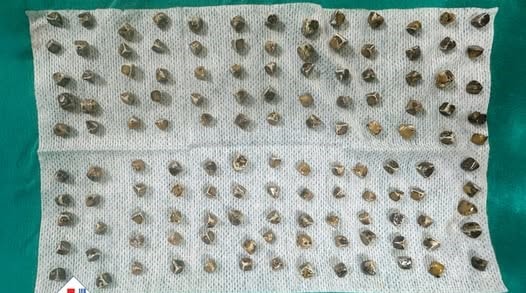 Đau bụng dữ dội, nữ bệnh nhân mang trong mình 130 viên sỏi