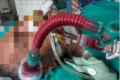 Can thiệp nút mạch cấp cứu thành công nam bệnh nhân ho ra máu “sét đánh”