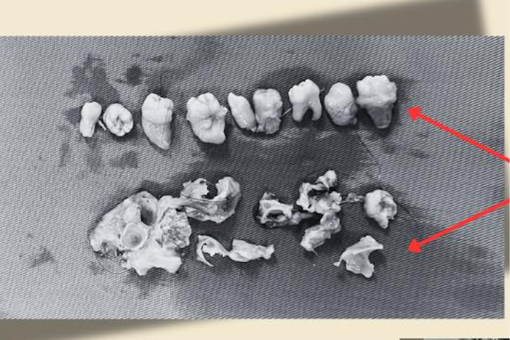 Bệnh nhân nữ 21 tuổi suýt mất khả năng làm mẹ do khối u quái có chứa xương, răng và tóc