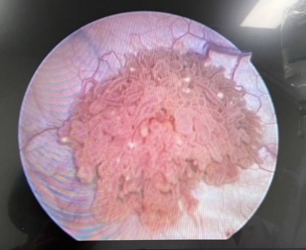 Không triệu chứng, cô gái 26 tuổi ngỡ ngàng khi phát hiện u bàng quang