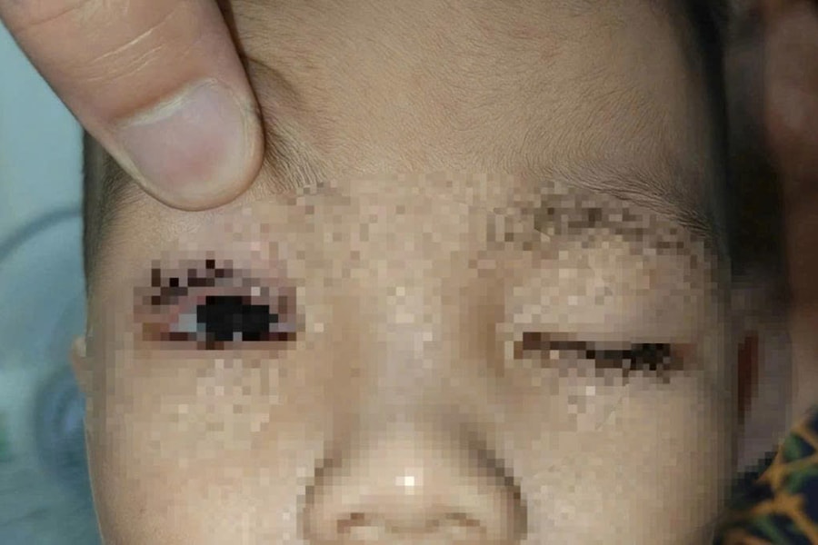 Bé trai 2 tuổi nhập viện vì bỏng mắt do pháo hoa Trung thu