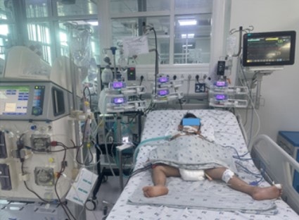 Lọc máu liên tục cứu sống trẻ bị ong vò vẽ đốt 35 mũi