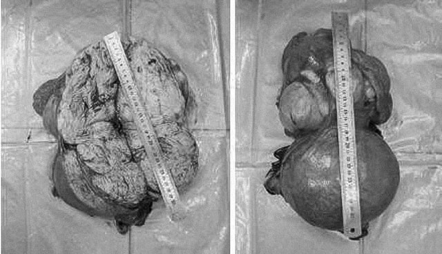 Tưởng lầm mang song thai, người phụ nữ phát hiện khối u tử cung khổng lồ 8kg