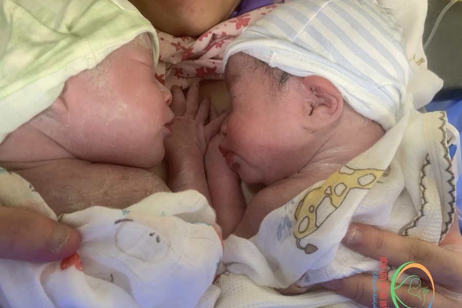 Cặp song sinh ở Quảng Ninh chào đời còn nguyên bọc ối