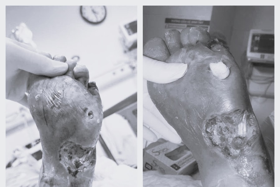 Bệnh nhân đái tháo đường nặng thoát nguy cơ cắt cụt chi