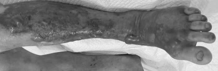 Nguy cơ nhiễm khuẩn "ăn thịt người" từ hải sản sống và nước biển