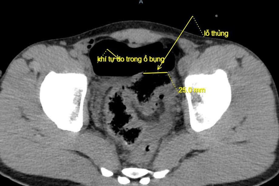 Hy hữu: Trêu đùa bằng vòi xịt rửa xe gây thủng đại tràng