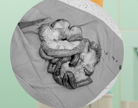 Phẫu thuật cắt 5 mét ruột non cứu bệnh nhân tắc động mạch hiếm gặp