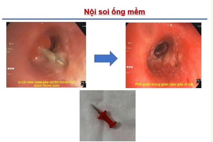 Bệnh nhi 13 tuổi hít phải đinh ghim khi đang xem điện thoại