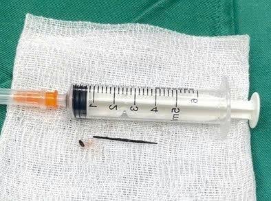 Hy hữu: Dị vật “đi lạc” từ dạ dày vào tụy, gây áp xe nguy hiểm