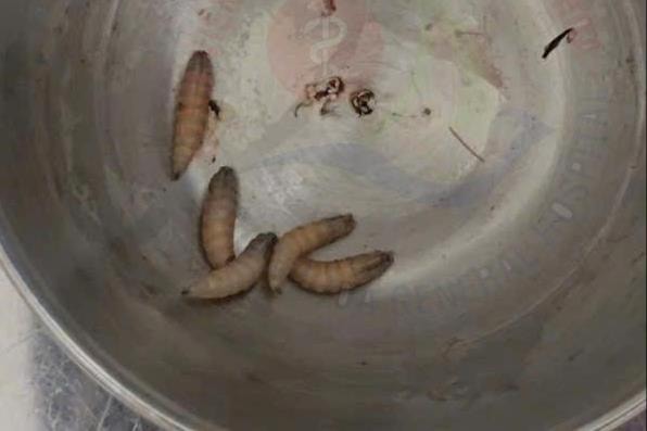 Gắp 5 con giòi sống làm tổ trong tai người phụ nữ