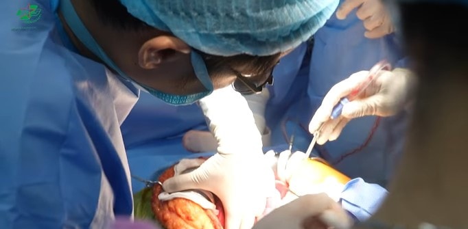 Ca ghép gan hồi sinh bệnh nhân từng "chờ chết"