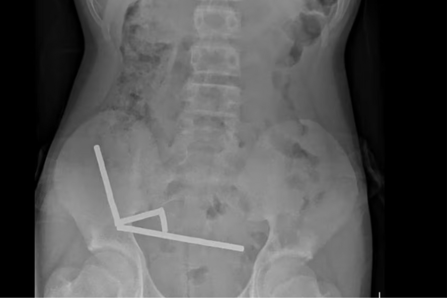 Bé trai phải cắt ruột sau khi nuốt 100 viên nam châm