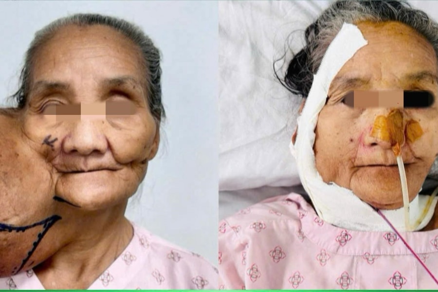 Ca phẫu thuật nhân đạo giúp người phụ nữ thoát khối u  đeo bám suốt 4 thập kỷ
