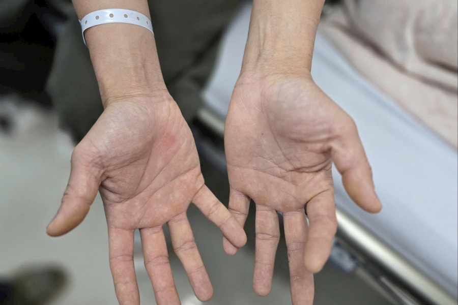 Từ quả bóng cười cho vui đến liệt nửa người: Lời cảnh báo từ Bệnh viện Bạch Mai