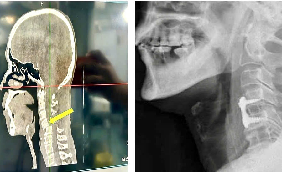 Thoát nguy cơ liệt tứ chi sau ca phẫu thuật trật đốt sống cổ hiếm gặp