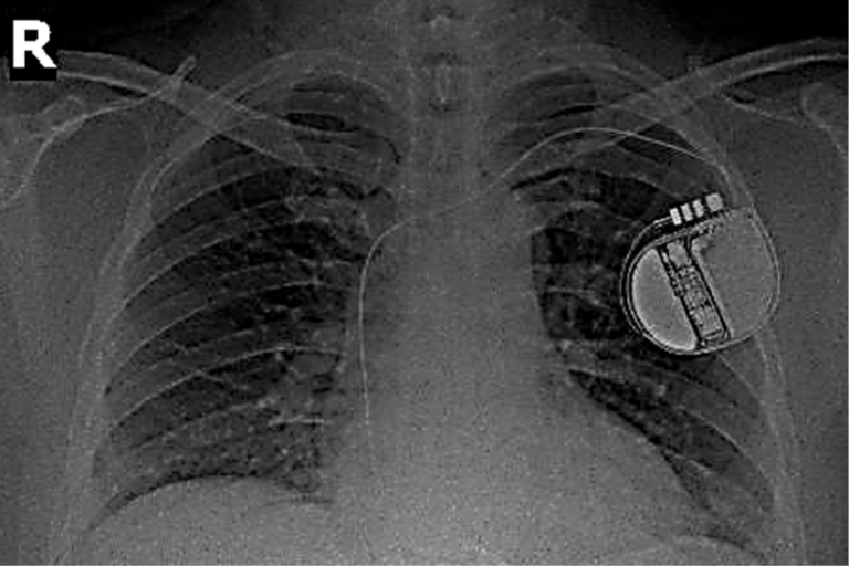 Thoát khỏi tử thần nhờ thiết bị phá rung tim cấy ghép trong cơ thể