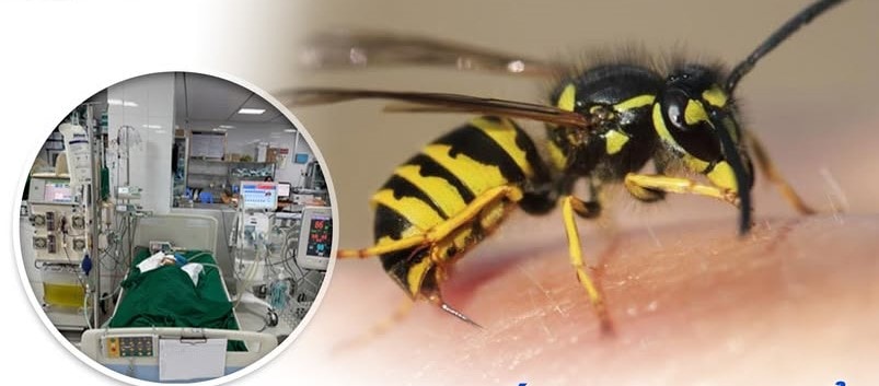 Cứu sống bé gái 9 tuổi bị ong vò vẽ đốt hơn 50 nốt, suy đa tạng nguy kịch