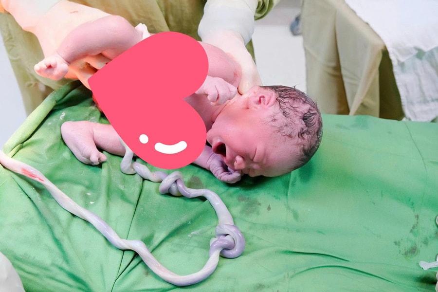 Bé trai 3,3kg chào đời an toàn dù dây rốn thắt hai nút hiếm gặp
