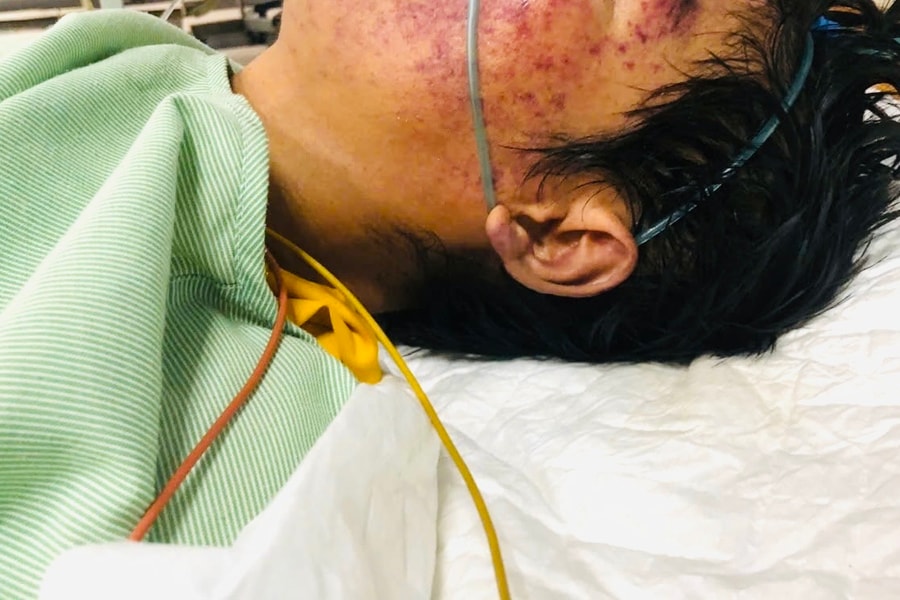 Liên cầu lợn tấn công, nam bệnh nhân nguy kịch sau bữa tiết canh