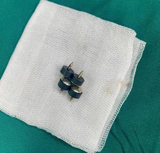 Cấp cứu bé 2 tuổi nuốt 4 viên đinh nam châm nguy cơ thủng ruột
