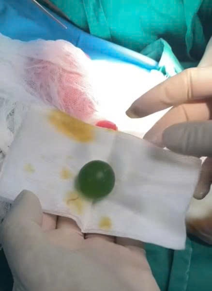 Cấp cứu bé 13 tháng tuổi bị tắc ruột do hạt nở phình to
