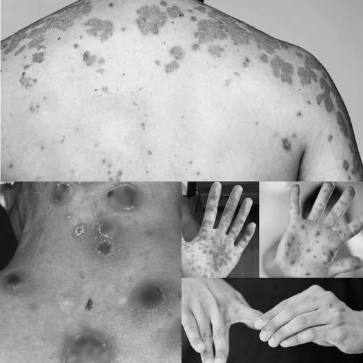 Gia tăng ca HIV nặng do phát hiện muộn, chuyên gia cảnh báo nguy cơ