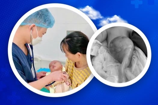 Cứu sống bé sơ sinh mắc thoát vị rốn “khổng lồ” hiếm gặp