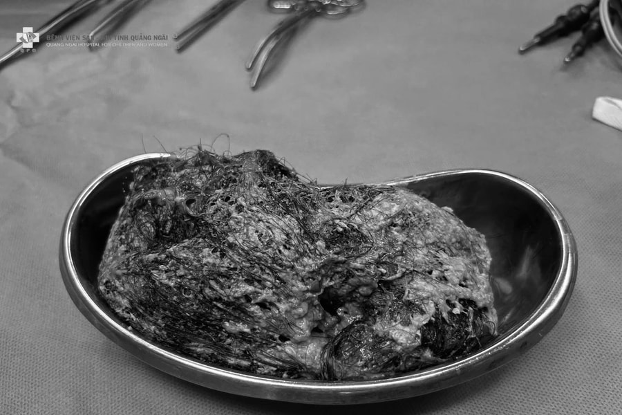 Bé gái 6 tuổi được phẫu thuật lấy búi tóc 0,5 kg chiếm trọn dạ dày