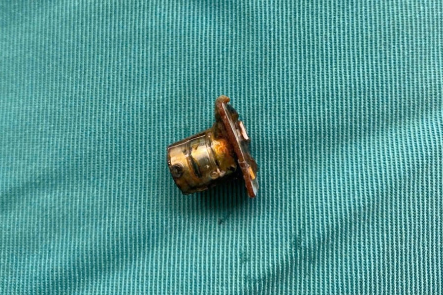 Cấp cứu kịp thời bé trai 2 tuổi nuốt pin cúc áo