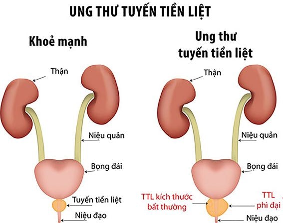 Ung thư tuyến tiền liệt gia tăng, nhiều ca phát hiện ở giai đoạn muộn