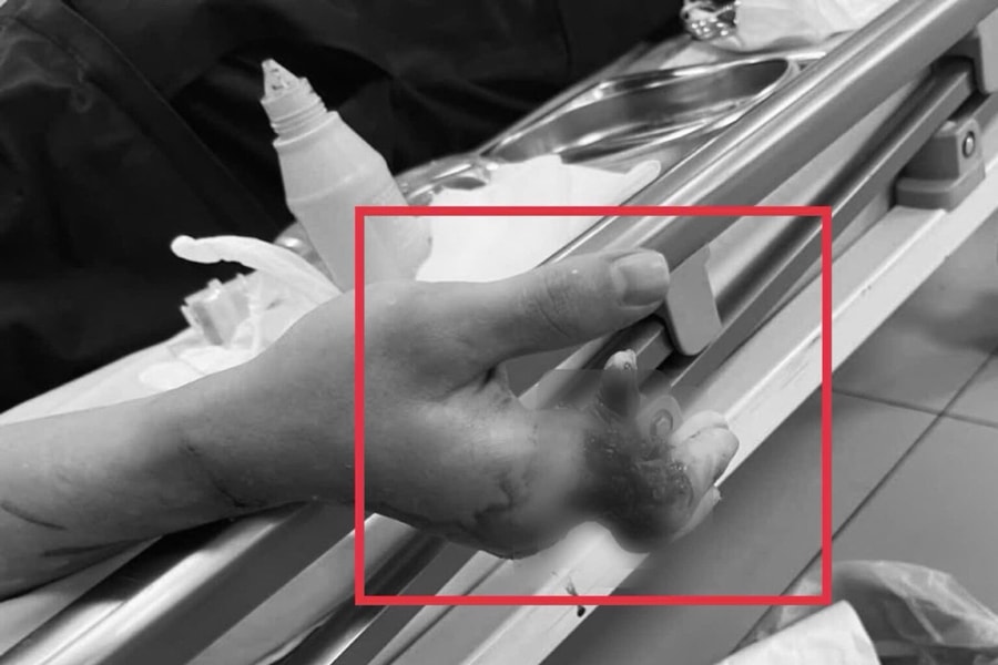 12 giờ phẫu thuật dưới kính hiển vi cứu bàn tay bị đứt 4 ngón
