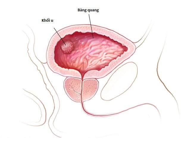 Hút thuốc lá gây nguy cơ hàng đầu ung thư bàng quang