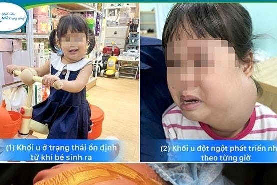 Bé gái 2 tuổi nguy kịch do u nang bạch huyết vùng cổ phát triển đột ngột