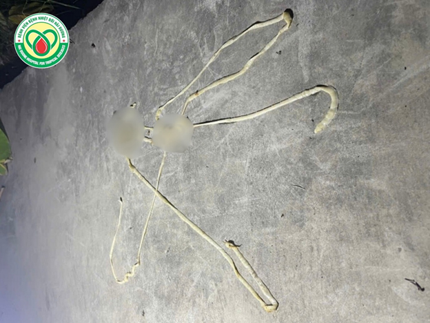 Sán lợn dài 10 mét trong cơ thể người đàn ông hay ăn gỏi cá, tôm, tiết canh