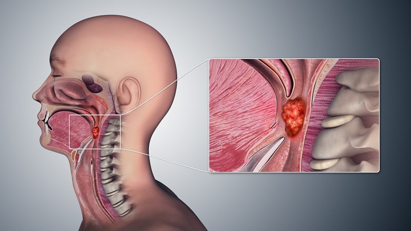 Những dấu hiệu cảnh báo ung thư vòm họng