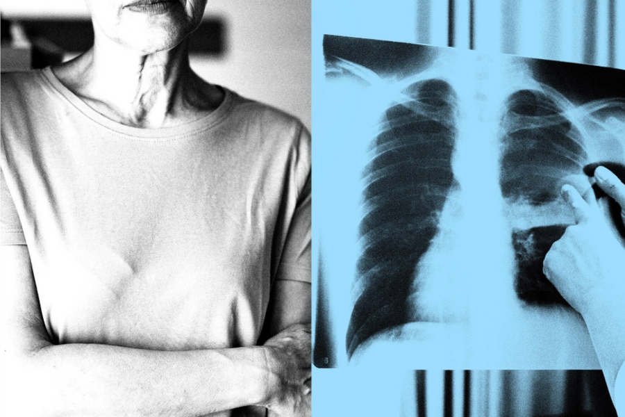 Vì sao ung thư có thể tái phát sau nhiều năm - và cách ngăn chặn từ gốc