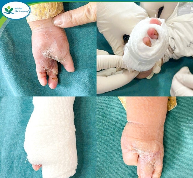 Bé 8 tháng tuổi bị máy tuốt lúa cuốn bàn tay trái
