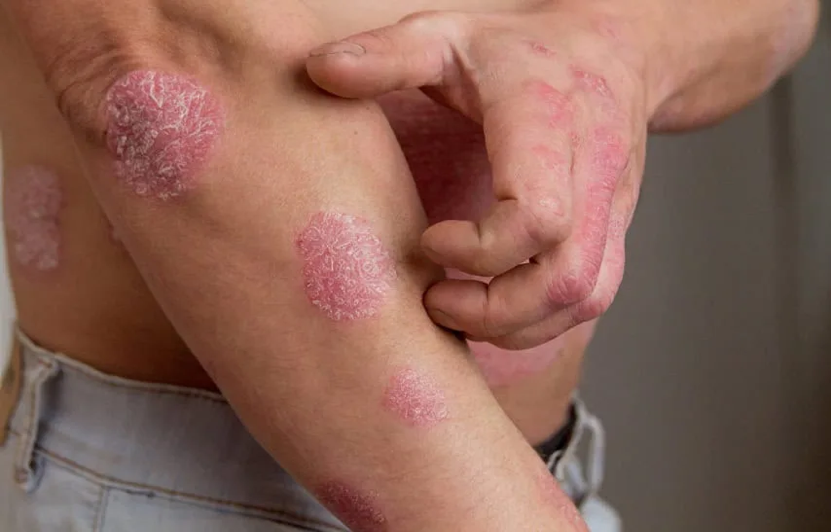 Cảnh giác các bệnh da thường gặp trong mùa lạnh
