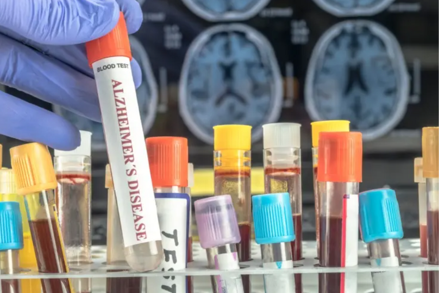 Sàng lọc Alzheimer sớm hơn, rẻ hơn nhờ công nghệ mới