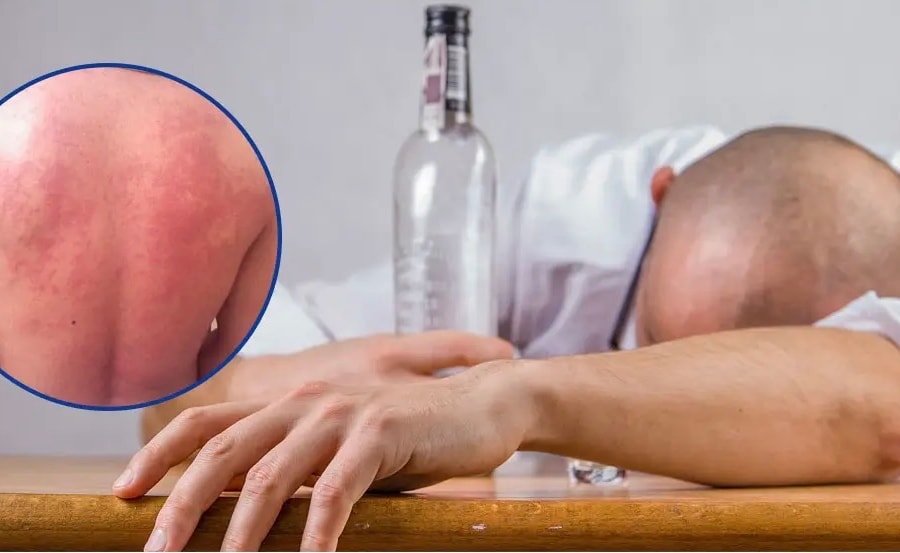 Không chủ quan khi uống rượu bia ngày tết với tình trạng “mẩn ngứa, nóng bừng”
