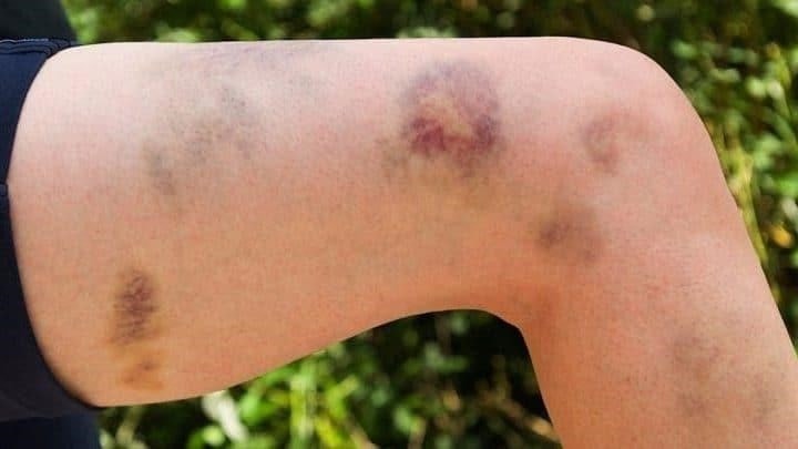 Dùng thuốc nam không rõ nguồn gốc, người phụ nữ mắc bệnh hiếm
