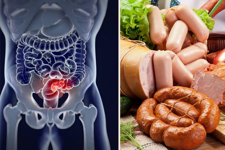 Nhiều người không biết loại thực phẩm phổ biến này làm tăng nguy cơ ung thư