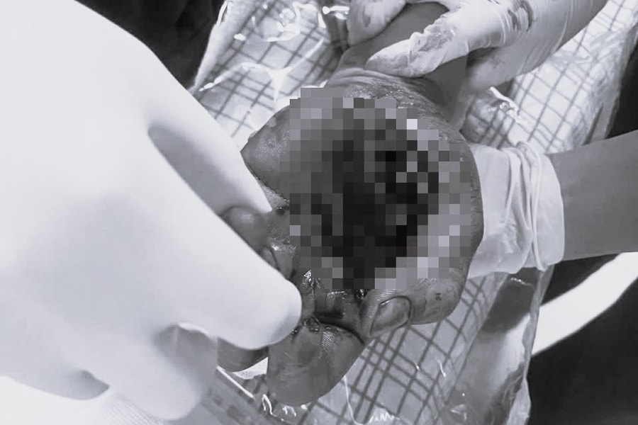 Pháo phát nổ ngay trên tay, nam thanh niên nhập viện với bàn tay dập nát