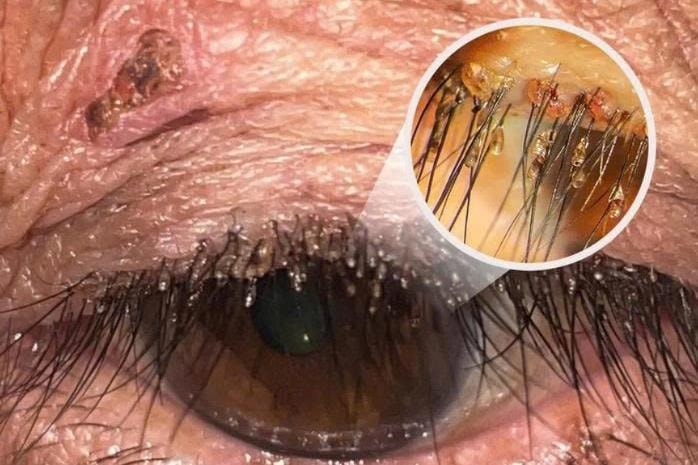 Đi khám vì ngứa mắt, phát hiện rận mu bám dày trên lông mi người phụ nữ