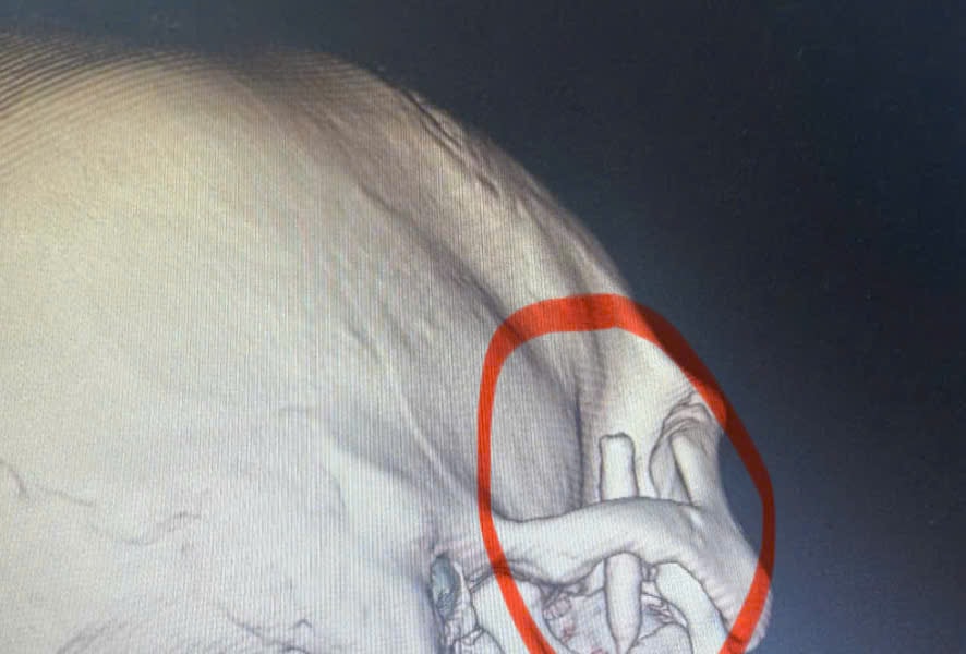 Hy hữu: Dị vật bút bi nằm sâu trong vùng thái dương suốt 13 năm