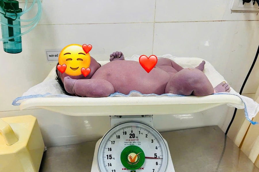 Ca sinh đặc biệt: Bé trai nặng 5,4kg chào đời an toàn trên nền sẹo mổ cũ