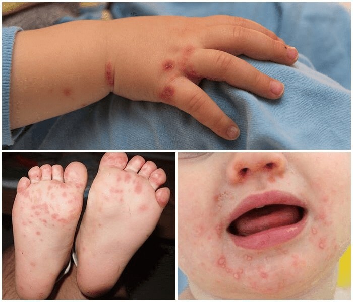 Bệnh lây nhiễm tay chân miệng tăng cao, Bộ Y tế chỉ đạo khẩn