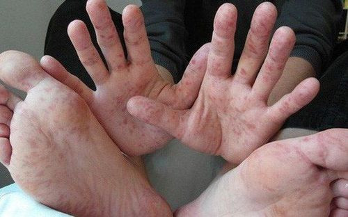 Đã có 8 ca tử vong do dịch tay chân miệng, Bộ Lô Đề QQ88k khuyến cáo phòng bệnh